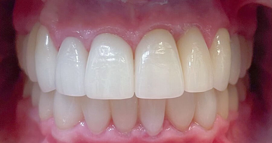 Crowns After