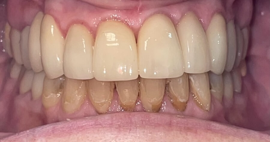 Crowns Before