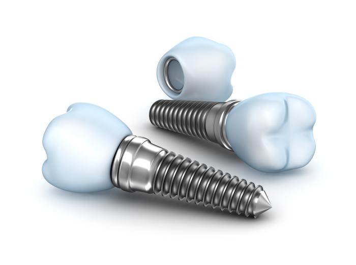“Can dental implants fall out?”: Recognizing the Signs of Dental Implant Failure