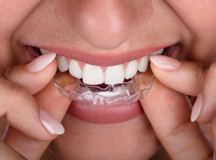 Teeth Whitening and Orthodontics: How to Brighten Your Smile with Braces or Aligners