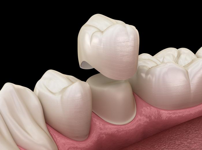 How Dental Caps (Crowns) Restore Teeth in Las Vegas, NV