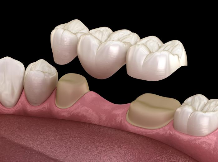 Bridging the Gap: Understanding the Difference Between Dental Bridges and Partial Dentures