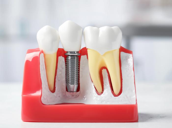 Lose the Dentures, Boost Your Confidence: Discover Dental Implants in Vegas