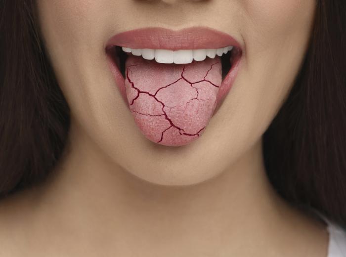 When Your Mouth Feels Like the Mojave: Real Relief for Dry Mouth