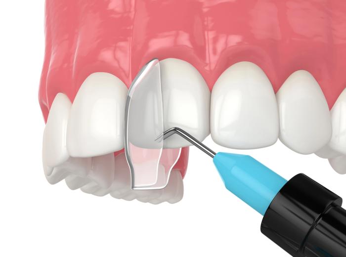 Dental Bonding & Contouring for a Sensational Smile