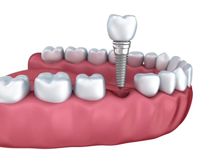 When Are Dental Implants A Great Decision?