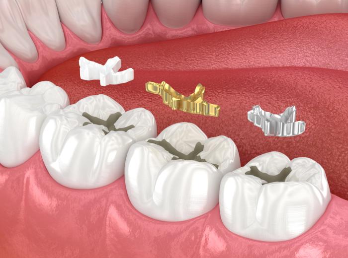 Can Dental Fillings Cause Sensitivity? Here’s the Truth