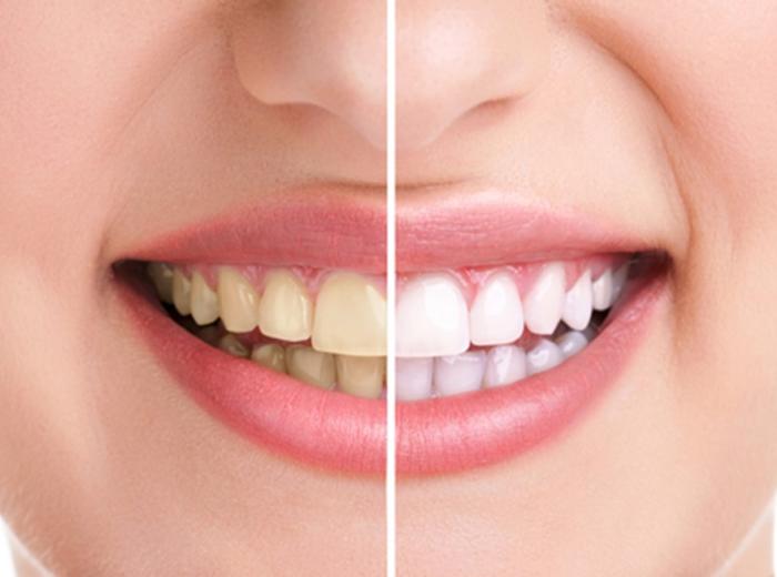 5 Benefits of Professional Teeth Whitening