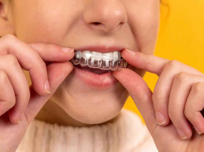 “How can I speed up Invisalign treatment?” & Other Clear Aligner FAQs