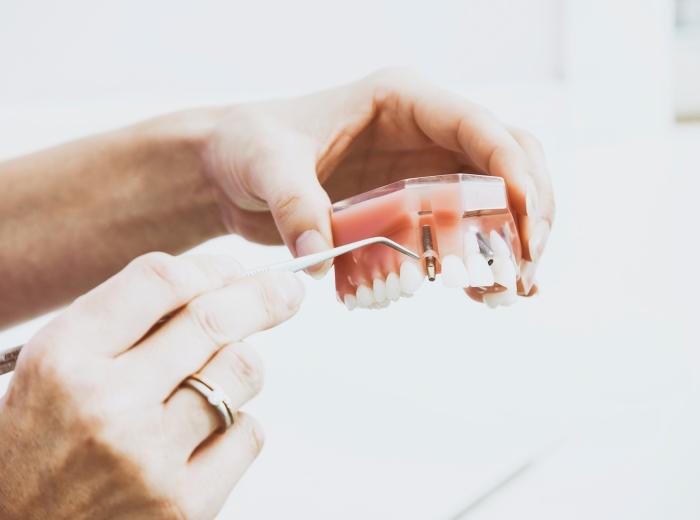 What You Should Know Before Getting Dental Implants