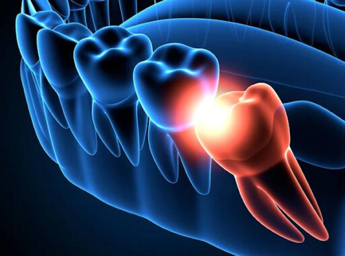 Learn the Basics About Wisdom Tooth Extraction